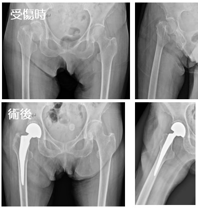 大腿骨頸部骨折の手術 手外科 外傷 おおさかグローバル整形外科病院 大阪市城東区 脊椎 人工関節 スポーツ整形 ペインクリニック 牧ヘルスケアグループ 医療法人 清翠会