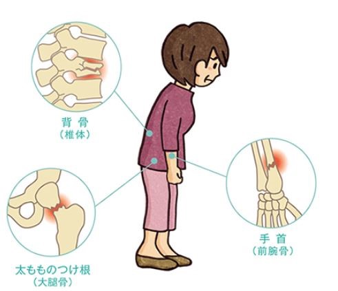 骨粗鬆症性脊椎圧迫骨折 脊椎外科 おおさかグローバル整形外科病院 大阪市城東区 脊椎 人工関節 スポーツ整形 ペインクリニック 牧ヘルスケアグループ 医療法人 清翠会