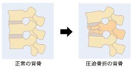 骨粗鬆症性脊椎圧迫骨折 脊椎外科 牧整形外科病院 大阪市城東区 脊椎 人工関節 スポーツ整形 ペインクリニック 牧ヘルスケアグループ 医療法人 清翠会