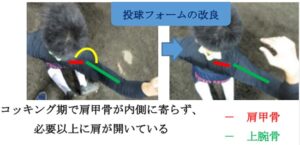 投球障害肩 Slap損傷 肩関節外科 牧整形外科病院 大阪市城東区 脊椎 人工関節 スポーツ整形 ペインクリニック 牧ヘルスケアグループ 医療法人 清翠会