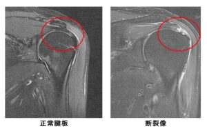 腱板断裂 肩関節外科 おおさかグローバル整形外科病院 大阪市城東区 脊椎 人工関節 スポーツ整形 ペインクリニック 牧ヘルスケアグループ 医療法人 清翠会