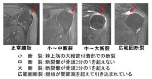 腱板断裂 肩関節外科 おおさかグローバル整形外科病院 大阪市城東区 脊椎 人工関節 スポーツ整形 ペインクリニック 牧ヘルスケアグループ 医療法人 清翠会